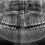 Панорамная рентгенограмма зубных рядов (ортопантомограмма) фотография