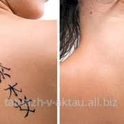 Удаление татуировок лазером фотография