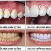 Лечение зубных каналов фотография