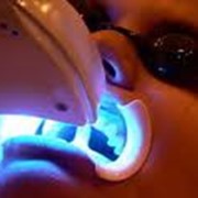 Лазерное отбеливание зубов