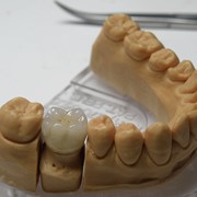 Изготовление зубных имплантов фотография