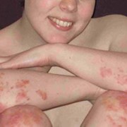 Гипноз против аллергии. фото