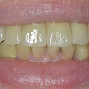 Имплантация при полной потере зубов фотография