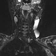Магнитно-резонансная томография образований мягких тканей фото