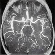 Ангиография артерий головного мозга