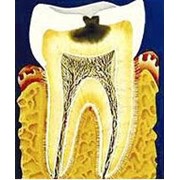 Терапевтическое лечение зубов: кариеса, некариозных поражений зубов