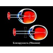 Лечение близорукости - дальнозоркости фото