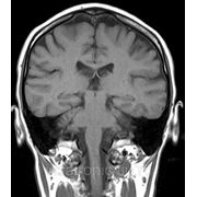 МРТ диагностика головного мозга