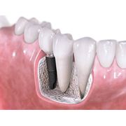 Установка зубного протеза на имплантаты