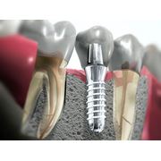 Имплантология - имплантация зубов фото