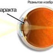 Лечение катаракты фото