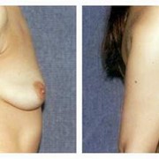 Маммопластика (операция увеличения груди) фото