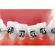 Ортодонтическое лечение фото