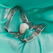 Реставрация зубов фото