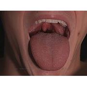 Лечение заболеваний слизистой оболочки полости рта фото