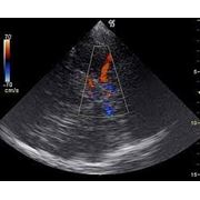 Динамическая эходопплерография артериальных и венозных сосудов нижних конечностей