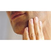 Лазерная эпиляция: зона верхней губы у мужчин