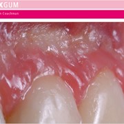 Зубные импланты фото