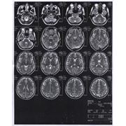 Магнитно-резонансная томография головного мозга фотография