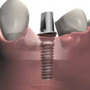 Установка зубного протеза на импланты фотография