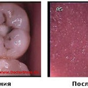 Лечение кариеса, Стоматологические услуги, Стоматология фото