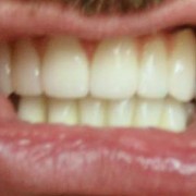 Протезирование зубов съемное