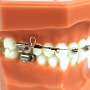 Биметрична дуга для дистализации верхней челюсти Wilson 3D