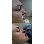 Ринопластика носа (безоперационная пластика носа)