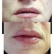 Увеличение губ гиалуроновой кислотой фотография