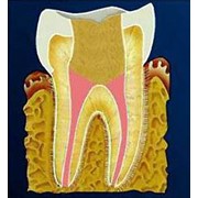 Пломбирование корневых каналов зубов