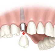 Имплантанты зубные