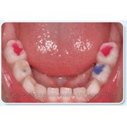 Лечение молочных зубов материалом Twinky Star фото