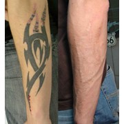Удаление татуировок и татуажа фото