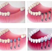 Имплантанты стоматологические