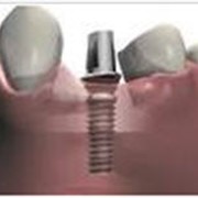 Восстановление утраченных зубов - имплантация фотография