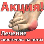 Лечение «КОСТОЧЕК» (шишек) на ногах без операции фото