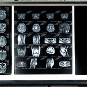 Негатоскопы для просмотра рентгенограмм Dixion X-View LED