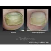 Лазеротерапия грибковых заболеваний ногтя фото