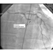 Диагностика и стентирование коронарных артерий