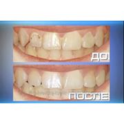 Лечение одного зуба при поверхностном и среднем кариесе без наложения постоянной пломбы