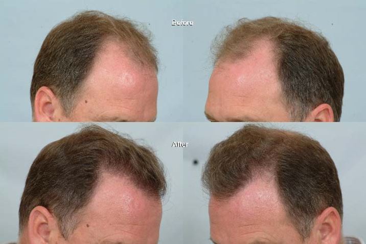 Пересадка волос воронеж. Пересадка волос до и после. Байден до и после пересадки волос.