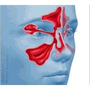 Спиральная компьютерная томография придаточных пазух носа фотография