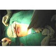 Оперирование грыжи с помощью сетчатых имплантов на основании вещества пролена в клинике Гиппократ