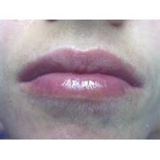 Увеличение губ гиалуроновой кислотой фото