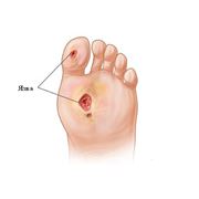 Лечение сах. диабета 2 типа и диабетической стопы при помощи лазера
