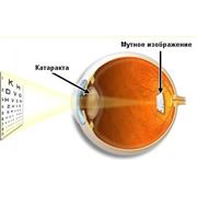 Лечение катаракты фотография