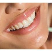 Косметическое восстановление зубов фотография