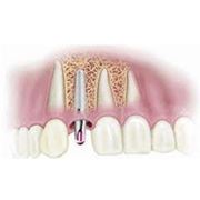 4D - зубная имплантология