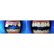Ортопедическая стоматология фото