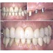 Имплантация зубов в Запорожье фото